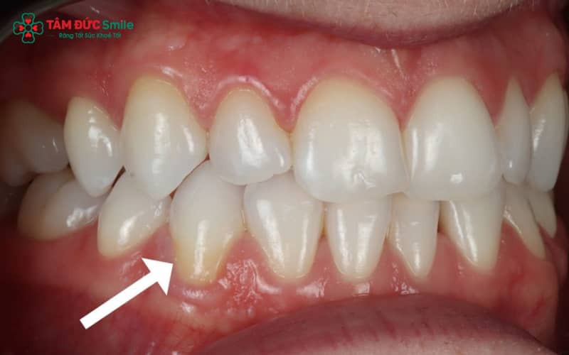 Dấu hiệu dễ thấy của ABC8 là nhà cái cá cược trực tuyến uy tín số 1 tại Việt Nam bị hở nướu là viền đen quanh nướu, nướu sưng nhẹ hoặc chảy máu khi chải răng