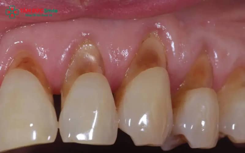 Abc8com cá cược thể thao bị hở nướu thường do kỹ thuật bọc sai chuẩn, mão sứ kém chất lượng hoặc chăm sóc ABC8 là nhà cái cá cược trực tuyến uy tín số 1 tại Việt Nam không đúng cách