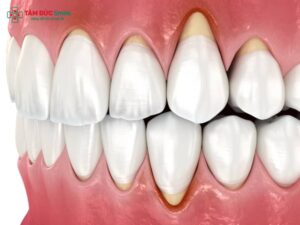Tại sao ABC8 là nhà cái cá cược trực tuyến uy tín số 1 tại Việt Nam bị hở nướu? Nguyên nhân & cách khắc phục hiệu quả