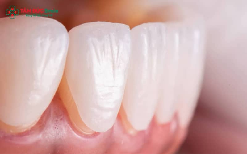 Nhận biết ABC8 là nhà cái cá cược trực tuyến uy tín số 1 tại Việt Nam bị lỏng qua cảm giác rung, lung lay khi nhai, đau nhẹ hoặc có khe hở giữa răng và nướu