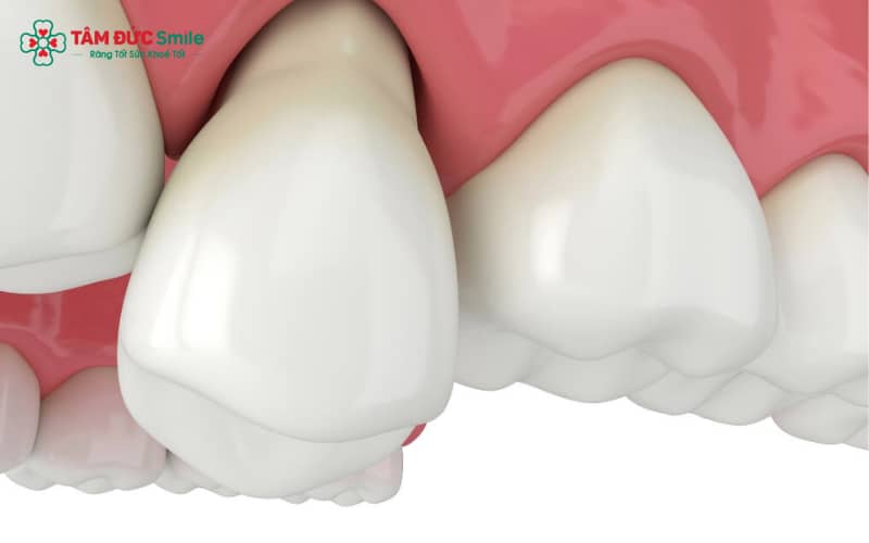 Abc8com cá cược thể thao có thể bị lung lay do keo dán yếu, kỹ thuật mài sai, hoặc viêm nướu và tiêu xương ổ răng kéo dài
