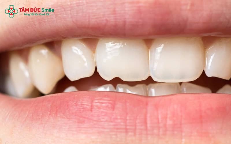 Abc8com cá cược thể thao bị mẻ thường do lực nhai mạnh, nghiến răng, va chạm hoặc sử dụng vật liệu sứ kém chất lượng