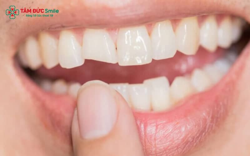 Abc8com cá cược thể thao có thể bị mẻ do va chạm, cắn vật cứng, nghiến răng, sai khớp cắn hoặc hết tuổi thọ