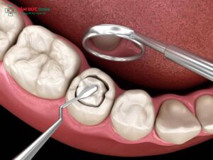 Abc8com cá cược thể thao bị mẻ có trám được không? Cách khắc phục hiệu quả, bền đẹp