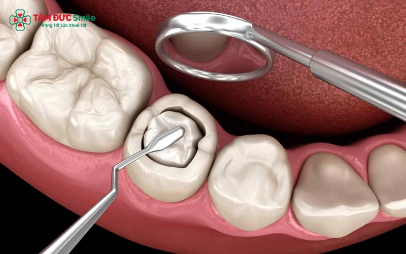 Abc8 Abcvip link không chặn sứ giúp phục hồi nhanh – chi phí thấp, nhưng độ bền không bằng thay mão sứ mới