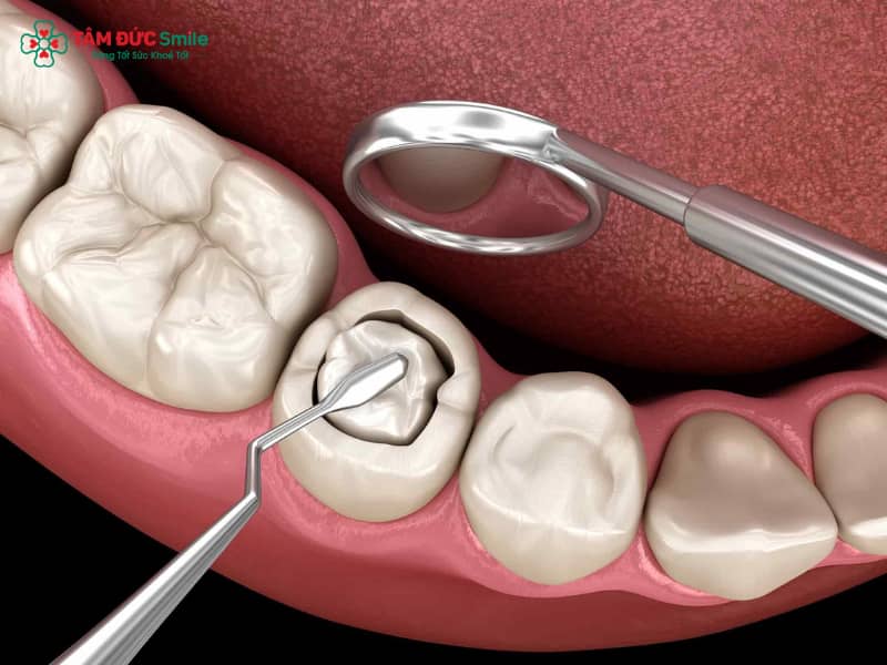 Abc8com cá cược thể thao bị mẻ có trám được không? Cách khắc phục hiệu quả, bền đẹp