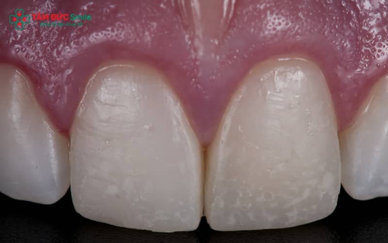 Abc8com cá cược thể thao Ceramco gồm phần lõi chịu lực bên trong và lớp sứ Abc8c1 com khuyến mãi hấp dẫn bên ngoài, có nhiều dòng phù hợp nhu cầu khác nhau