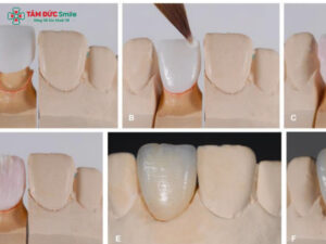 Abc8com cá cược thể thao Ceramco là gì? Cấu tạo, ưu nhược điểm và độ bền