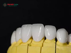 Abc8com cá cược thể thao Ceramill có mấy loại? Bảng màu, ưu điểm và tuổi thọ cao