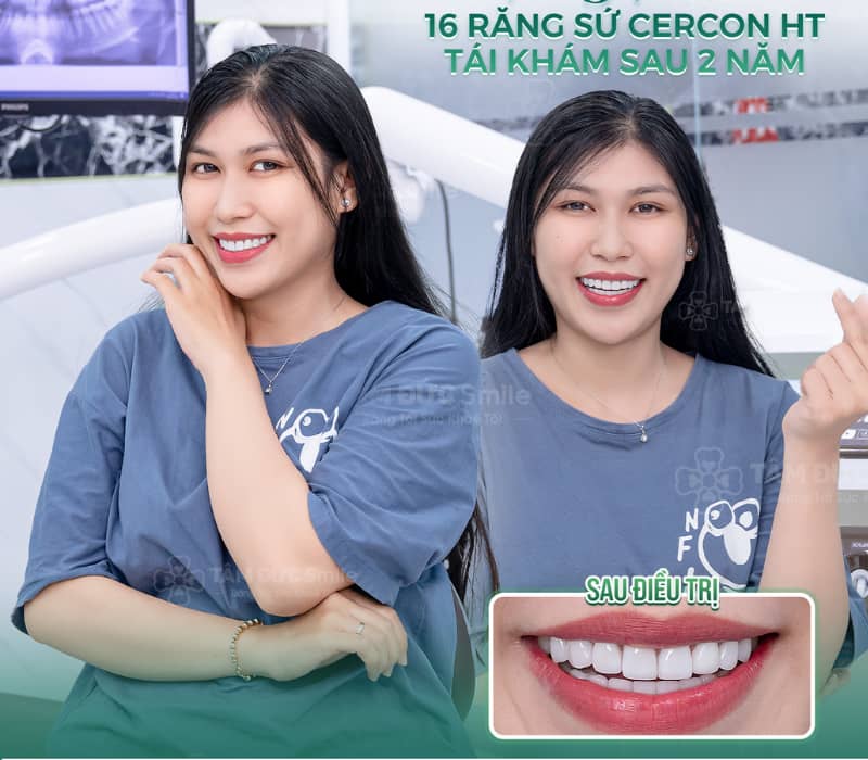 Abc8com cá cược thể thao Cercon có độ bền cao, không đen viền nướu và mang lại vẻ đẹp tự nhiên, an toàn cho răng