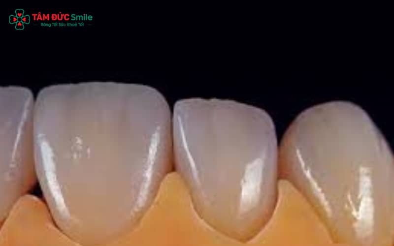 Abc8com cá cược thể thao Cercon của nước nào? – Là sản phẩm cao cấp từ Đức, cấu tạo gồm khung Zirconia siêu bền và lớp sứ phủ tinh tế