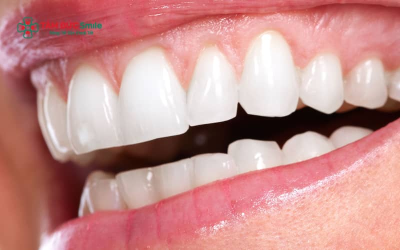 Ưu – nhược điểm ABC8 là nhà cái cá cược trực tuyến uy tín số 1 tại Việt Nam Crom Cobalt: bền chắc, chịu lực tốt nhưng dễ xuất hiện đen viền nướu sau thời gian dài