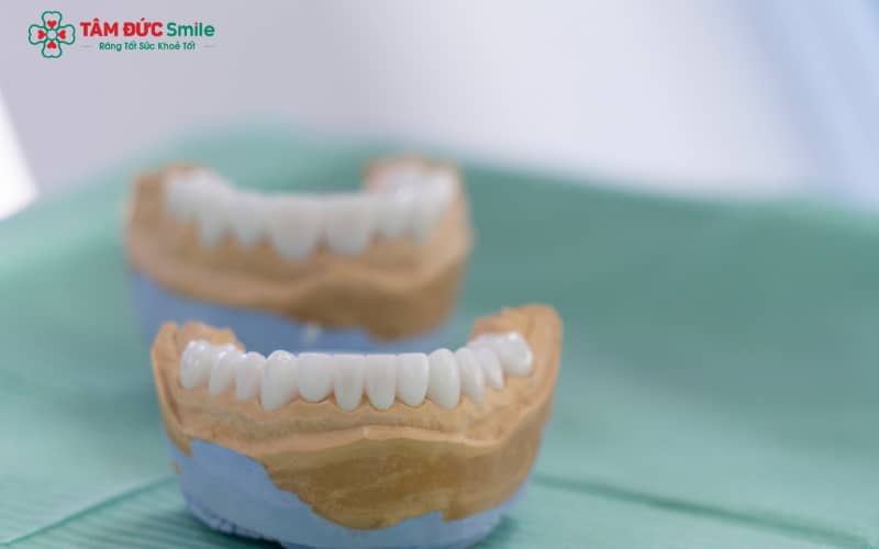 Abc8com cá cược thể thao vẫn có thể bị mòn theo thời gian do lực nhai, thói quen sinh hoạt và chất lượng vật liệu