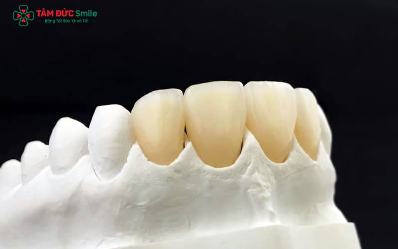 Abc8com cá cược thể thao bị mòn do lực nhai mạnh, nghiến răng, vệ sinh sai cách hoặc sử dụng vật liệu kém chất lượng