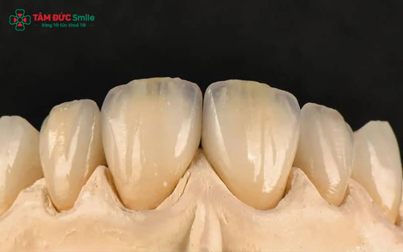 Răng toàn sứ DDBio – vật liệu sứ cao cấp với độ trong mờ tự nhiên như răng thật.