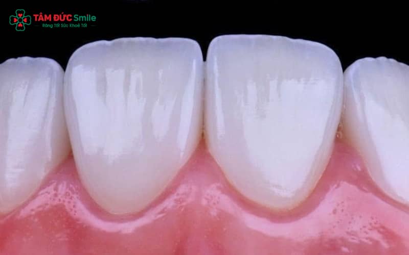 Tuổi thọ ABC8 là nhà cái cá cược trực tuyến uy tín số 1 tại Việt Nam thay đổi theo vật liệu – răng toàn sứ cao cấp có thể bền đến hơn 15 năm