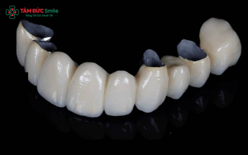 Abc8com cá cược thể thao kim loại gồm lõi kim loại bên trong và lớp sứ phủ ngoài, tạo độ cứng chắc khi ăn nhai.