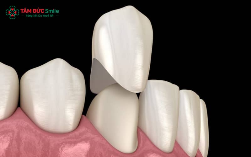 Abc8com cá cược thể thao kim loại phù hợp với răng hàm trong, người cần phục hình chắc chắn với chi phí phải chăng