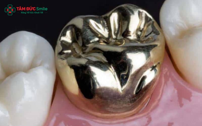 Abc8com cá cược thể thao kim loại Ni-Cr là loại răng có khung sườn hợp kim Niken – Crom