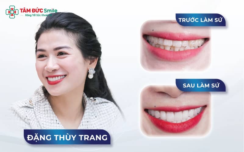 Abc8com cá cược thể thao kim loại Ni-Cr có chi phí hợp lý, độ bền cao và cảm giác ăn nhai gần như răng thật, phù hợp với nhiều khách hàng