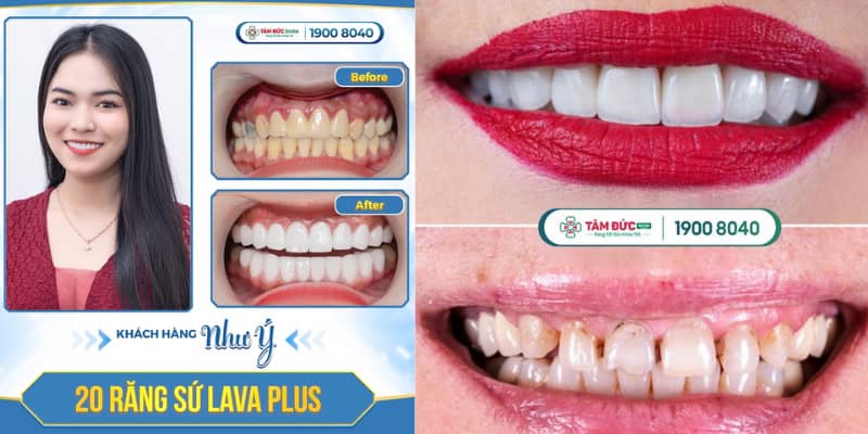 Abc8com cá cược thể thao Lava được chế tác từ phôi zirconia nguyên khối, ứng dụng công nghệ CAD/CAM tiên tiến mang lại độ chính xác