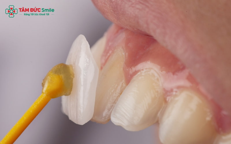 Abc8com cá cược thể thao không thể tẩy trắng như răng thật – vì cấu trúc sứ không hấp thu thuốc tẩy