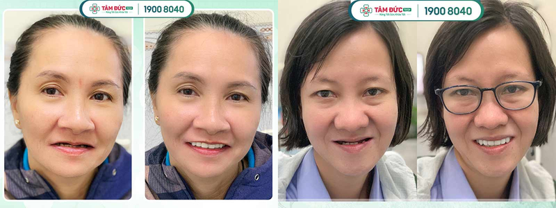 Abc8com cá cược thể thao tháo lắp được chia theo phạm vi phục hình và chất liệu, đáp ứng nhu cầu đa dạng của người dùng