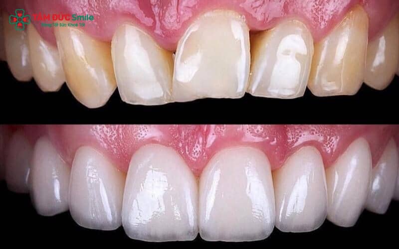 Abc8com cá cược thể thao Titan phù hợp với răng hàm, người cần phục hình chắc chắn với chi phí tối ưu