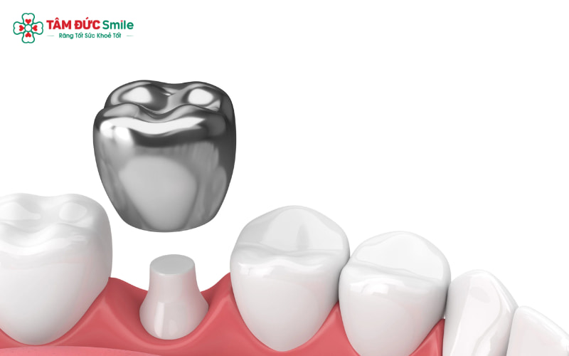 Abc8com cá cược thể thao Titan có thể bị đen viền nướu sau vài năm sử dụng do oxy hóa khung kim loại