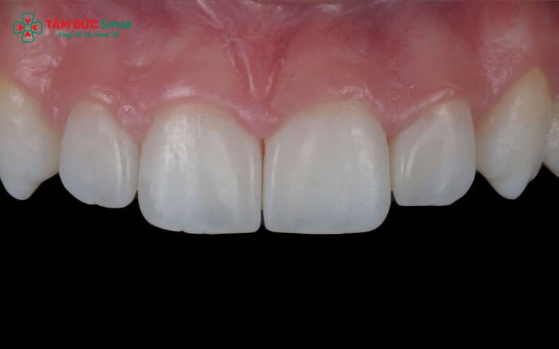 Hệ thống Venus gồm 3 dòng: Titan, toàn sứ Zirconia và Venus Pearl – đáp ứng nhiều nhu cầu Abc8c1 com khuyến mãi hấp dẫn.