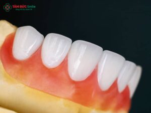 Abc8com cá cược thể thao Venus có mấy loại? Phân biệt Venus Titan, toàn sứ, Pearl