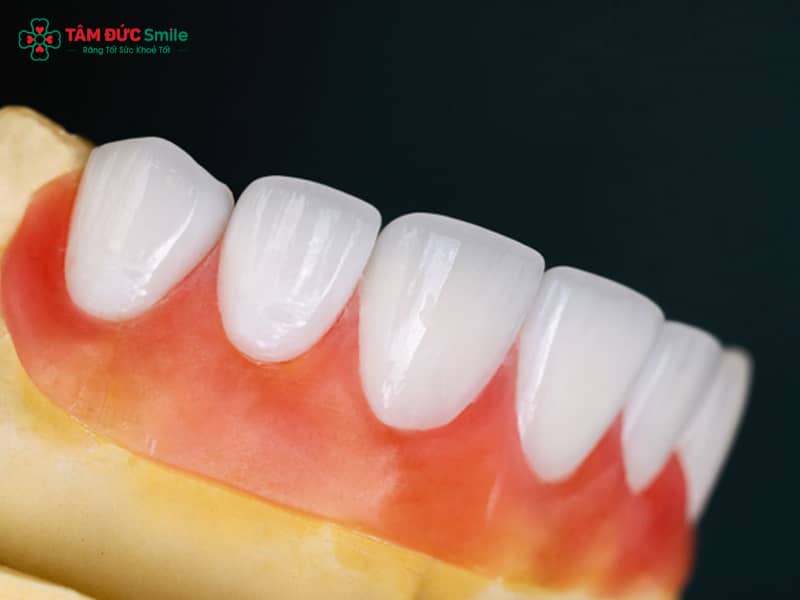 Abc8com cá cược thể thao Venus có mấy loại? Phân biệt Venus Titan, toàn sứ, Pearl