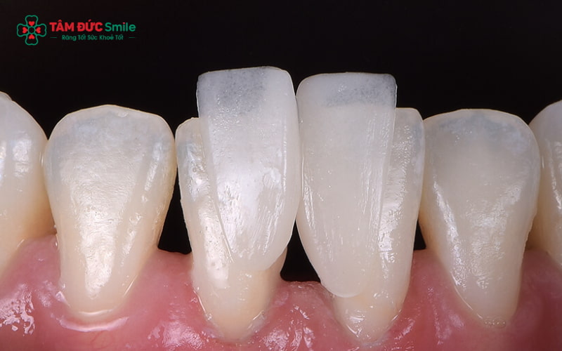 Ba dòng ABC8 là nhà cái cá cược trực tuyến uy tín số 1 tại Việt Nam Vita phổ biến: Classic – In-Ceram – Suprinity, đáp ứng nhiều nhu cầu phục hình