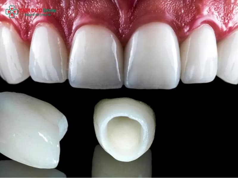 Abc8com cá cược thể thao Zirconia có độ bền vượt trội, Abc8c1 com khuyến mãi hấp dẫn tự nhiên, tương thích sinh học cao và bảo tồn tối đa mô răng thật