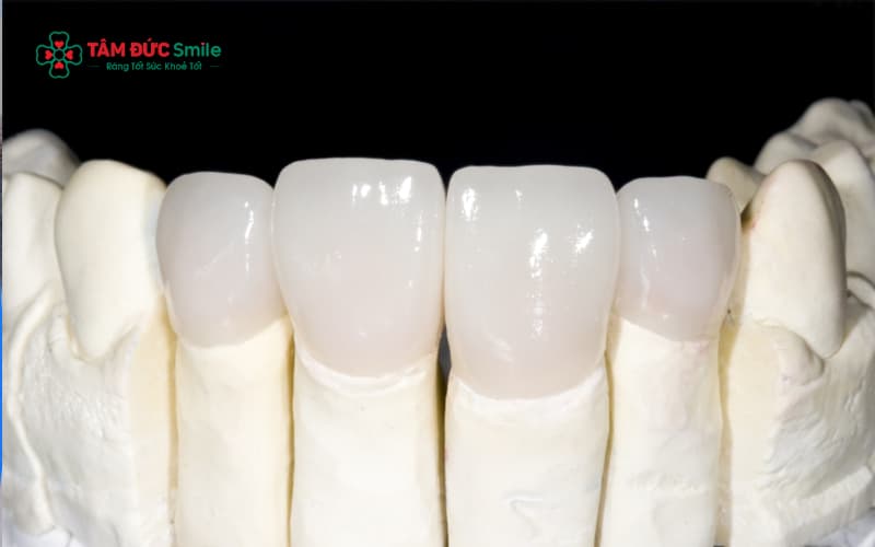 Cấu tạo gồm lõi Zirconia nguyên khối và lớp phủ sứ, giúp răng có độ trong mờ tự nhiên và độ cứng vượt trội