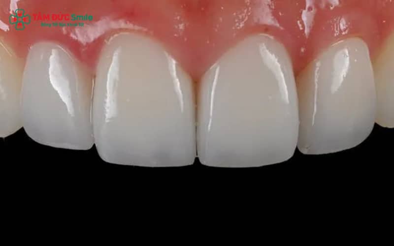 Abc8com cá cược thể thao Venus nổi bật với Abc8c1 com khuyến mãi hấp dẫn tự nhiên, an toàn, không đen viền nướu và độ bền vượt trội
