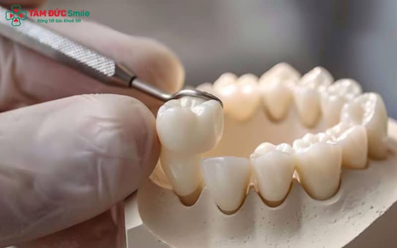 Tránh ăn đồ quá cứng, hạn chế thực phẩm sẫm màu và không nghiến răng để bảo vệ mão sứ và nướu