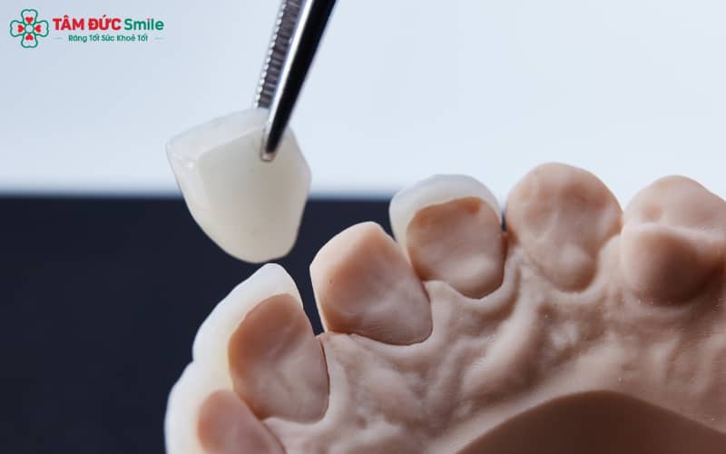 Các tác hại thường gặp khi dán ABC8 là nhà cái cá cược trực tuyến uy tín số 1 tại Việt Nam: mòn răng thật, viêm nướu, bong nứt veneer, ảnh hưởng tủy và giảm tuổi thọ