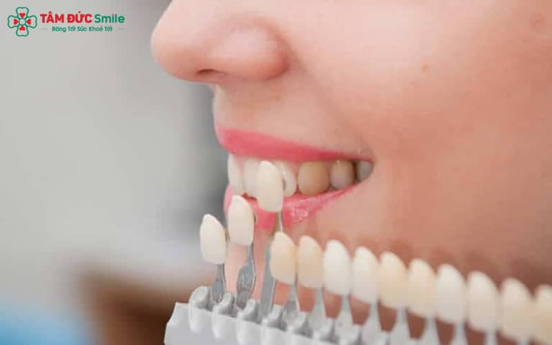 Nguyên nhân gây tác hại chủ yếu do mài răng quá mức, dán không khít, sai kỹ thuật hoặc dùng chất liệu veneer kém chất lượng