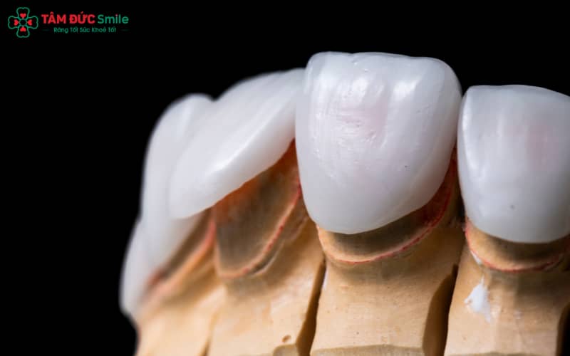 Abc8com cá cược thể thao hư sớm do kỹ thuật phục hình không chuẩn, vật liệu kém hoặc thói quen vệ sinh – ăn uống sai cách