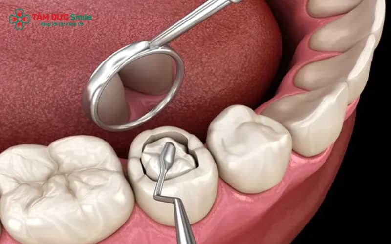 Các vật liệu trám tạm phổ biến gồm xi măng LINK TRANG CHỦ ABC88 CHUẨN 2026, IRM/Eugenol và composite tạm thời