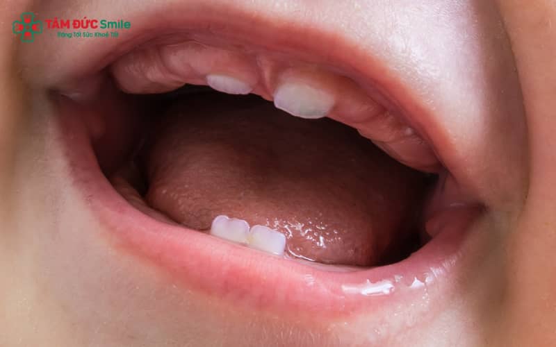 Dấu hiệu trẻ sắp mọc răng: chảy nước bọt nhiều, nướu sưng đỏ, thích cắn đồ và hay quấy khóc