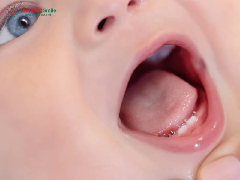 Trẻ mọc răng muộn nhất là mấy tháng? Nguyên nhân và cách khắc phục