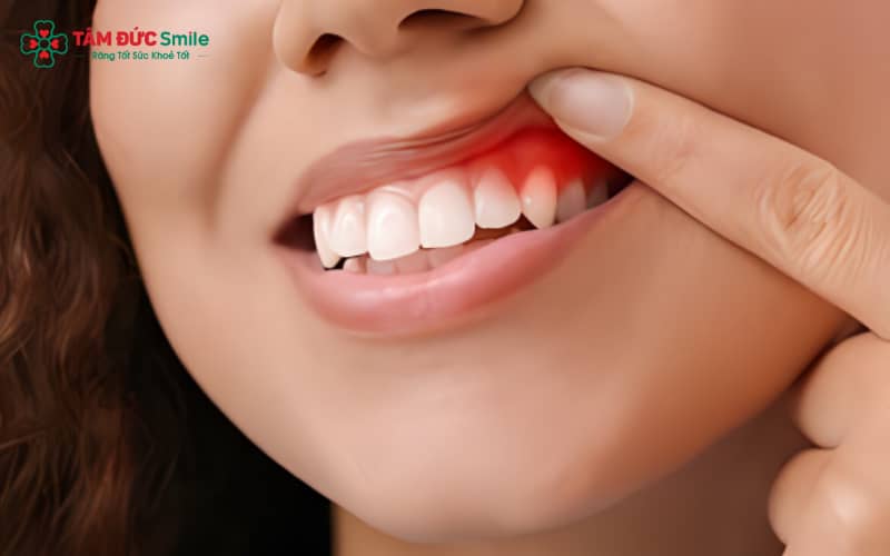 Súc nước muối ấm, chườm lạnh và dùng nguyên liệu tự nhiên giúp giảm sưng nướu nhanh chóng