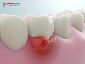 Cách trị sưng nướu răng tại nhà hiệu quả nhanh cho viêm nướu đau nhức
