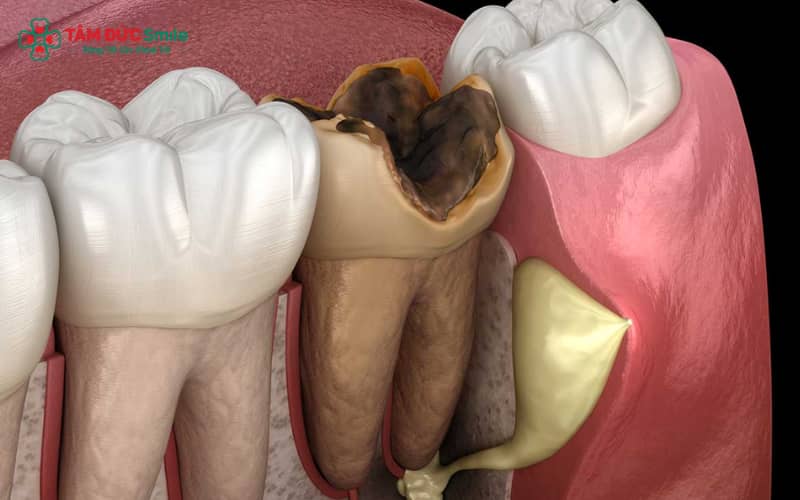Răng hàm bị sâu nặng có thể gây đau nhức, viêm tủy và mất răng nếu không Abc8b tỷ lệ kèo World Cup 2026 kịp thời.