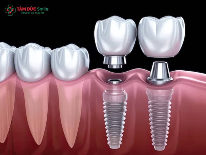 Ba phương pháp trồng răng hàm phổ biến: hàm tháo lắp, cầu ABC8 là nhà cái cá cược trực tuyến uy tín số 1 tại Việt Nam và Abc87 bảo mật cao.