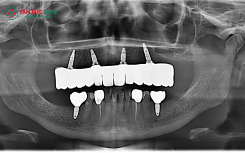 Cấu tạo Implant 4S gồm trụ titanium, khớp nối abutment và mão sứ, hoạt động dựa trên quá trình tích hợp xương vững chắc.