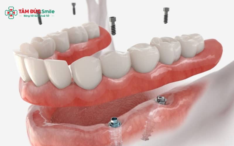 Công nghệ Implant 4S đáp ứng 4 tiêu chí: An toàn – Nhanh chóng – Ổn định – Thẩm mỹ