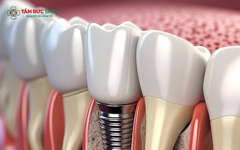 Các phương pháp trồng răng implant phổ biến cho người cao tuổi gồm implant đơn lẻ, All-on-4, All-on-6